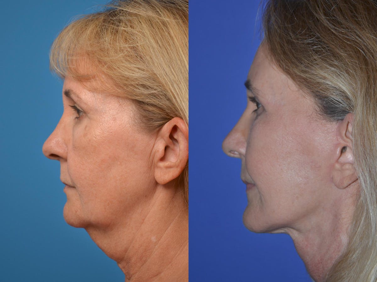 Facelift Before & After Gallery - Patient 122406051 - Image 2