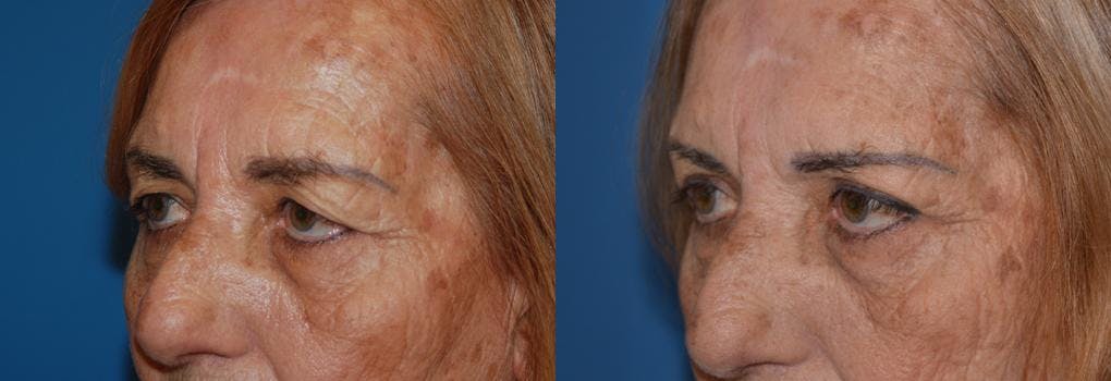 Eyelid Surgery Before & After Gallery - Patient 122406049 - Image 3