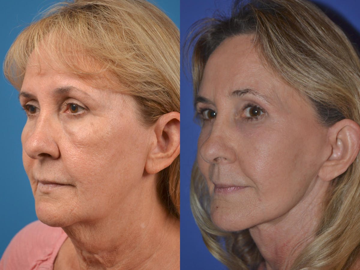Facelift Before & After Gallery - Patient 122406051 - Image 3