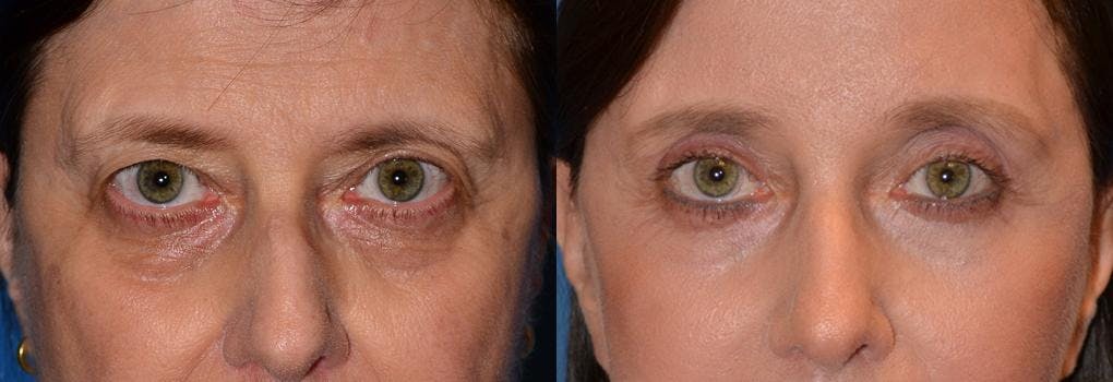 Eyelid Surgery Before & After Gallery - Patient 122406052 - Image 1