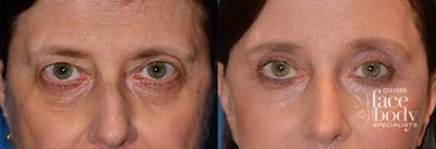 Eyelid Surgery Before & After Gallery - Patient 167895 - Image 1
