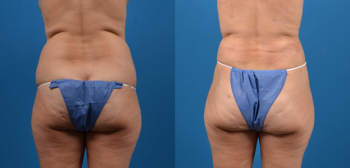 Liposuction Before & After Gallery - Patient 167951 - Image 4