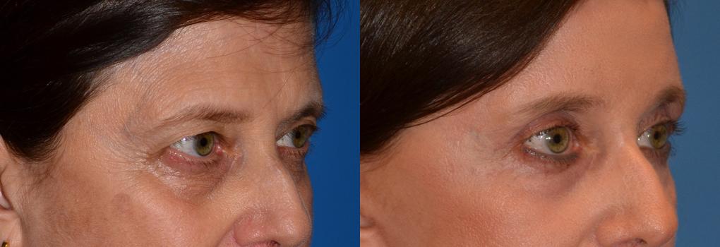 Eyelid Surgery Before & After Gallery - Patient 167895 - Image 2