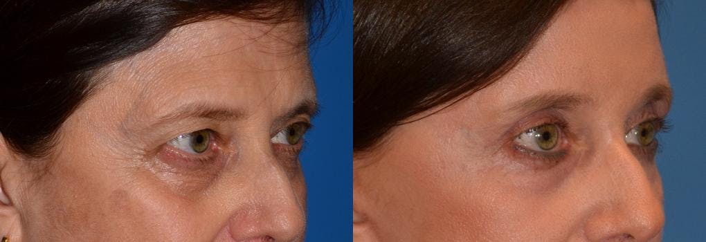 Eyelid Surgery Before & After Gallery - Patient 122406052 - Image 2