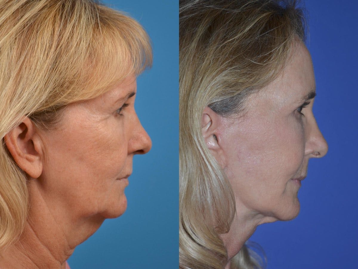 Facelift Before & After Gallery - Patient 122406051 - Image 5