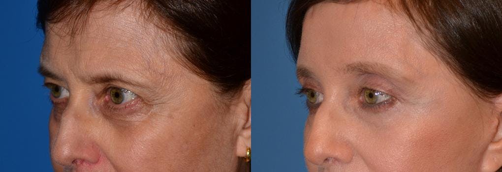 Eyelid Surgery Before & After Gallery - Patient 122406052 - Image 3