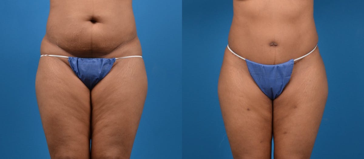 Liposuction Before & After Gallery - Patient 260083 - Image 1