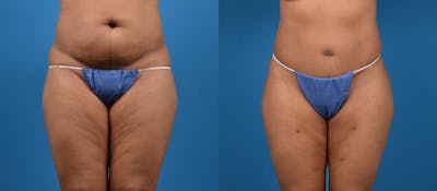 Liponique Body Contouring Before & After Gallery - Patient 122406054 - Image 1