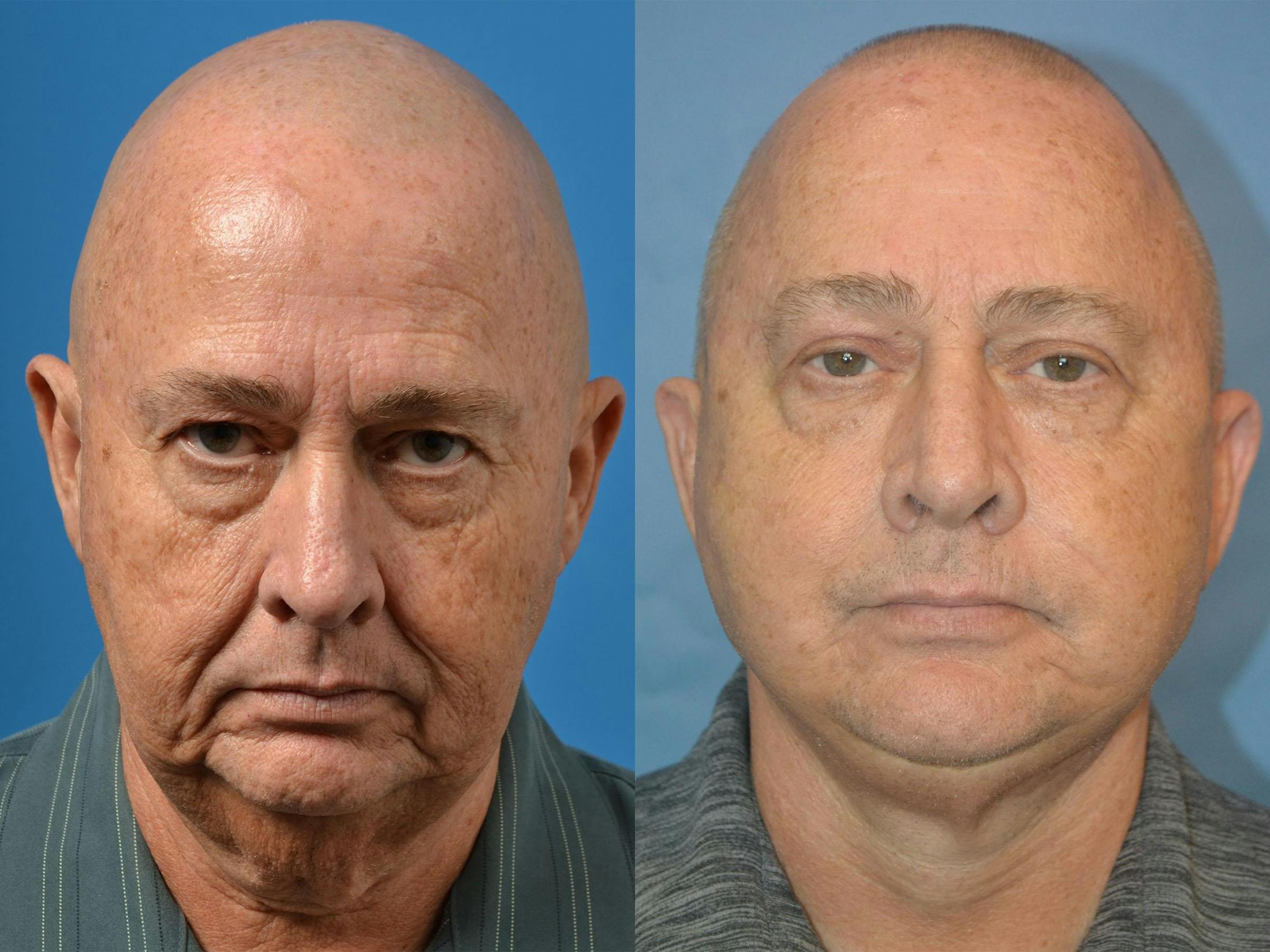 Facelift Before & After Gallery - Patient 122406055 - Image 1