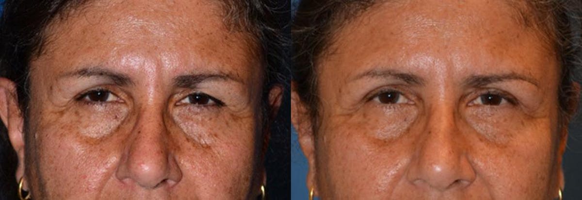 Eyelid Surgery Before & After Gallery - Patient 122406053 - Image 1