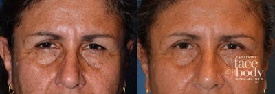 Eyelid Surgery Before & After Gallery - Patient 187545 - Image 1