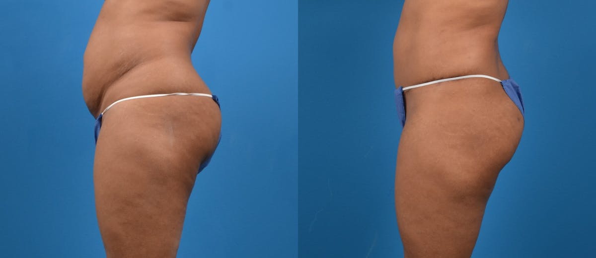 Liposuction Before & After Gallery - Patient 260083 - Image 2