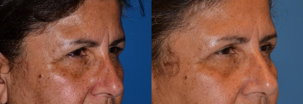 Eyelid Surgery Before & After Gallery - Patient 122406053 - Image 2