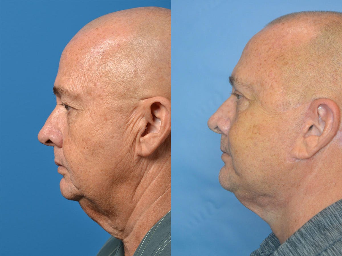 Facelift Before & After Gallery - Patient 122406055 - Image 2