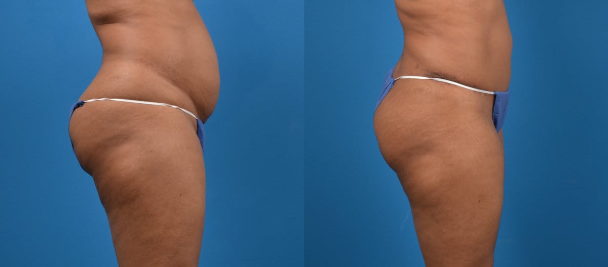 Liposuction Before & After Gallery - Patient 260083 - Image 3