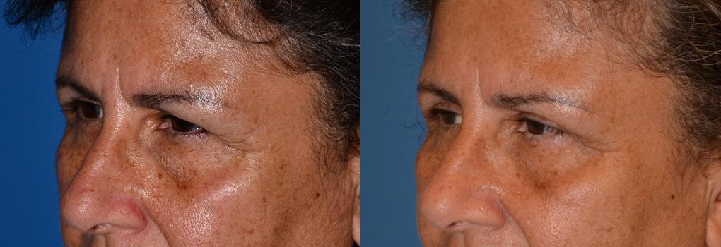 Eyelid Surgery Before & After Gallery - Patient 187545 - Image 3