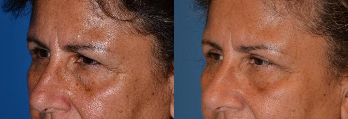 Eyelid Surgery Before & After Gallery - Patient 122406053 - Image 3
