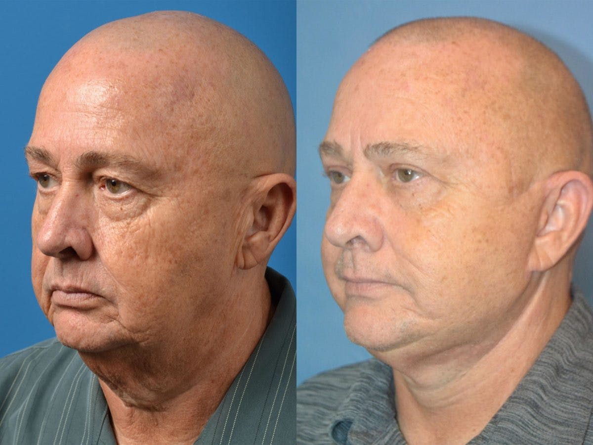 Facelift Before & After Gallery - Patient 122406055 - Image 3