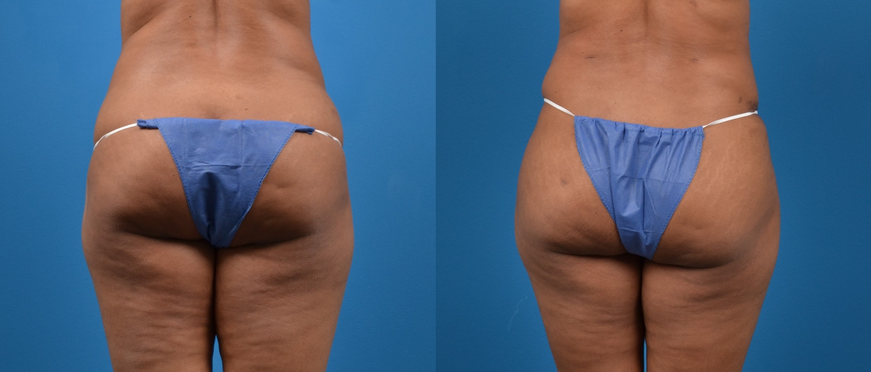 Hidden Liposuction  Before & After Gallery - Patient 159653 - Image 4