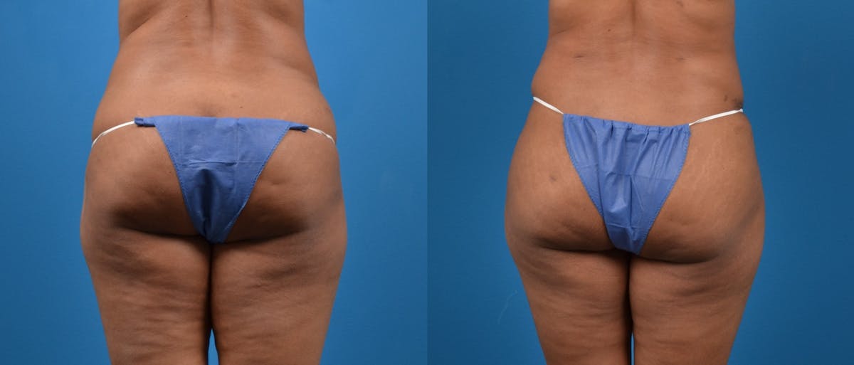 Liposuction Before & After Gallery - Patient 260083 - Image 4