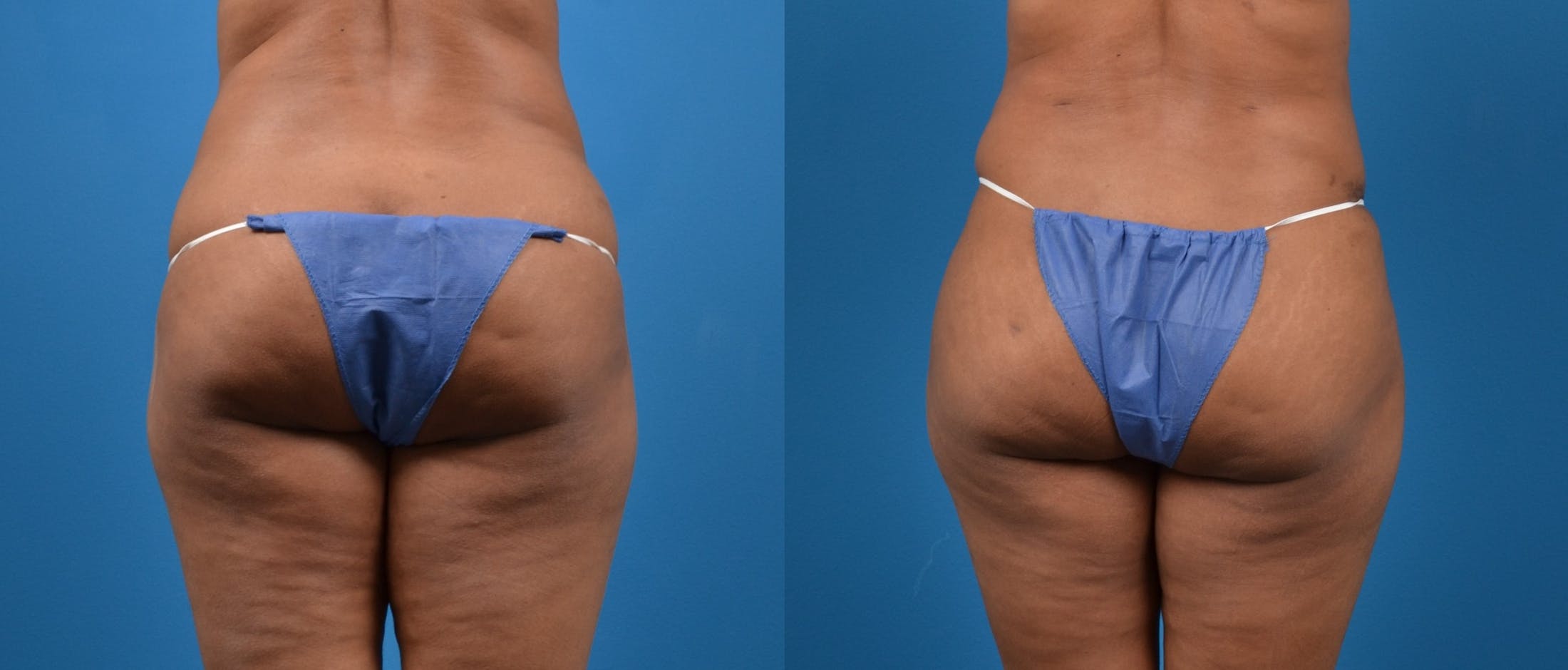 Liponique Body Contouring Before & After Gallery - Patient 122406054 - Image 4