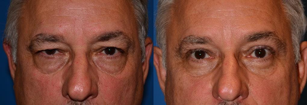 Eyelid Surgery Before & After Gallery - Patient 122406056 - Image 1