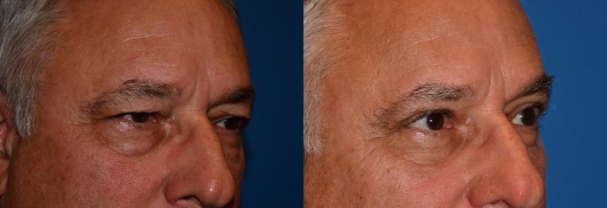 Eyelid Surgery Before & After Gallery - Patient 122406056 - Image 2