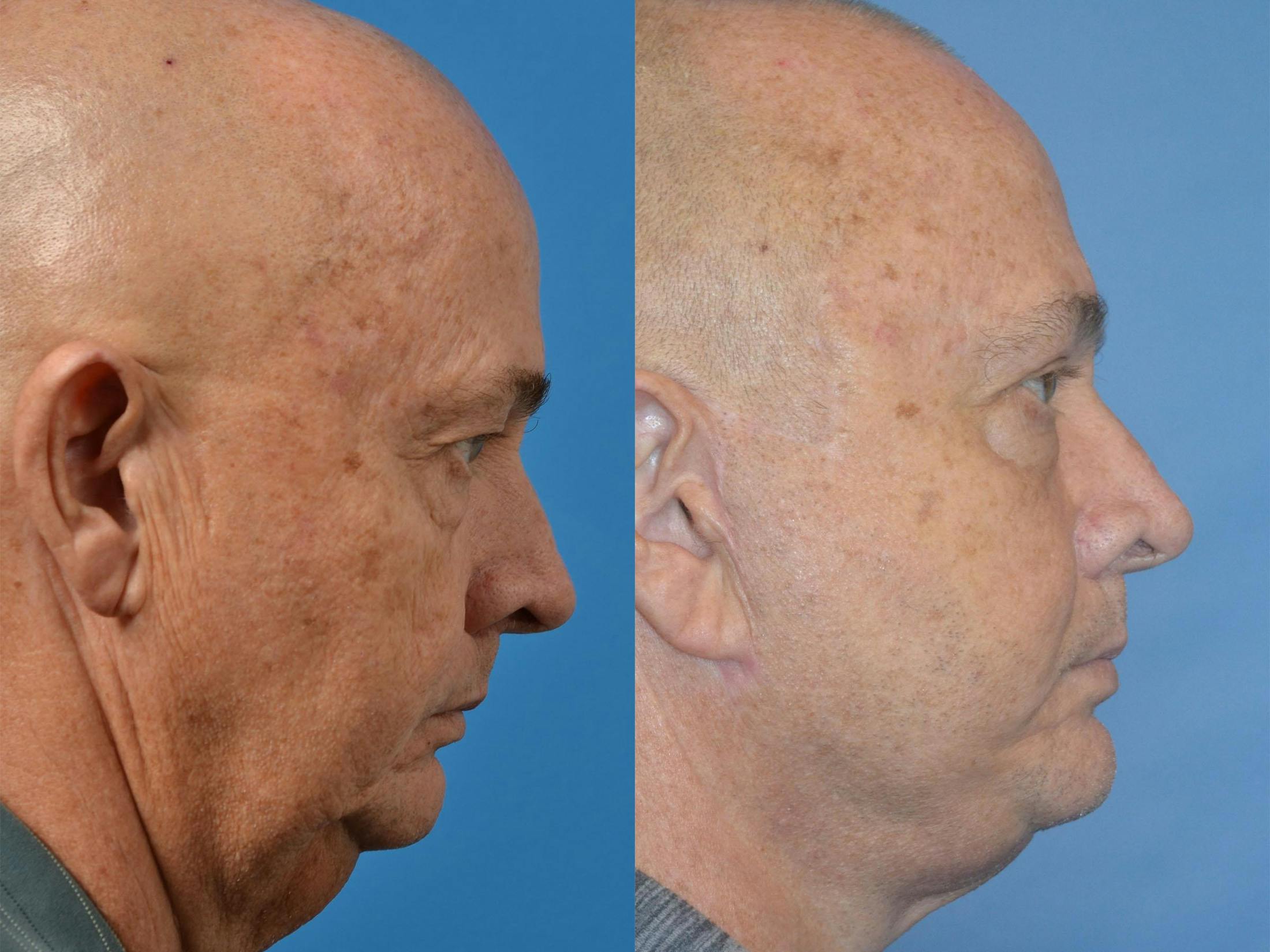 Facelift Before & After Gallery - Patient 122406055 - Image 5