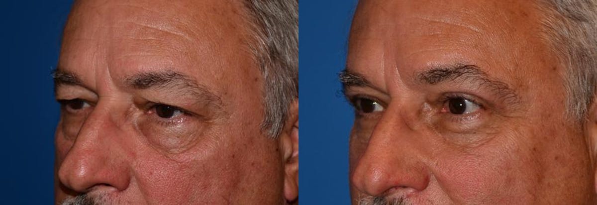 Eyelid Surgery Before & After Gallery - Patient 122406056 - Image 3