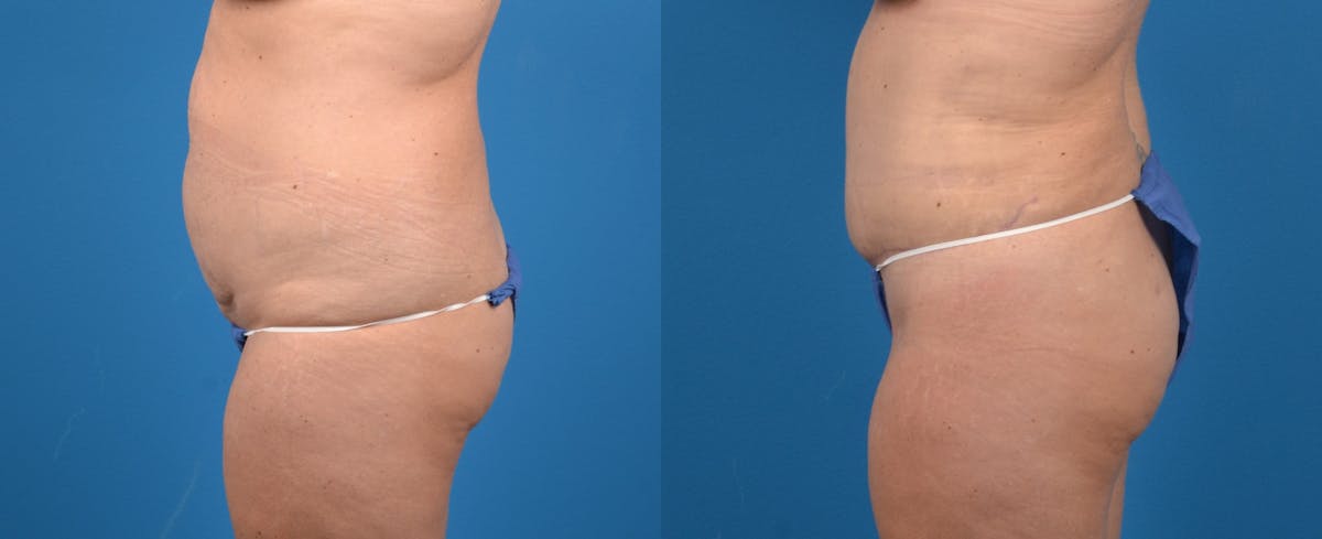 Hidden Liposuction  Before & After Gallery - Patient 336370 - Image 2