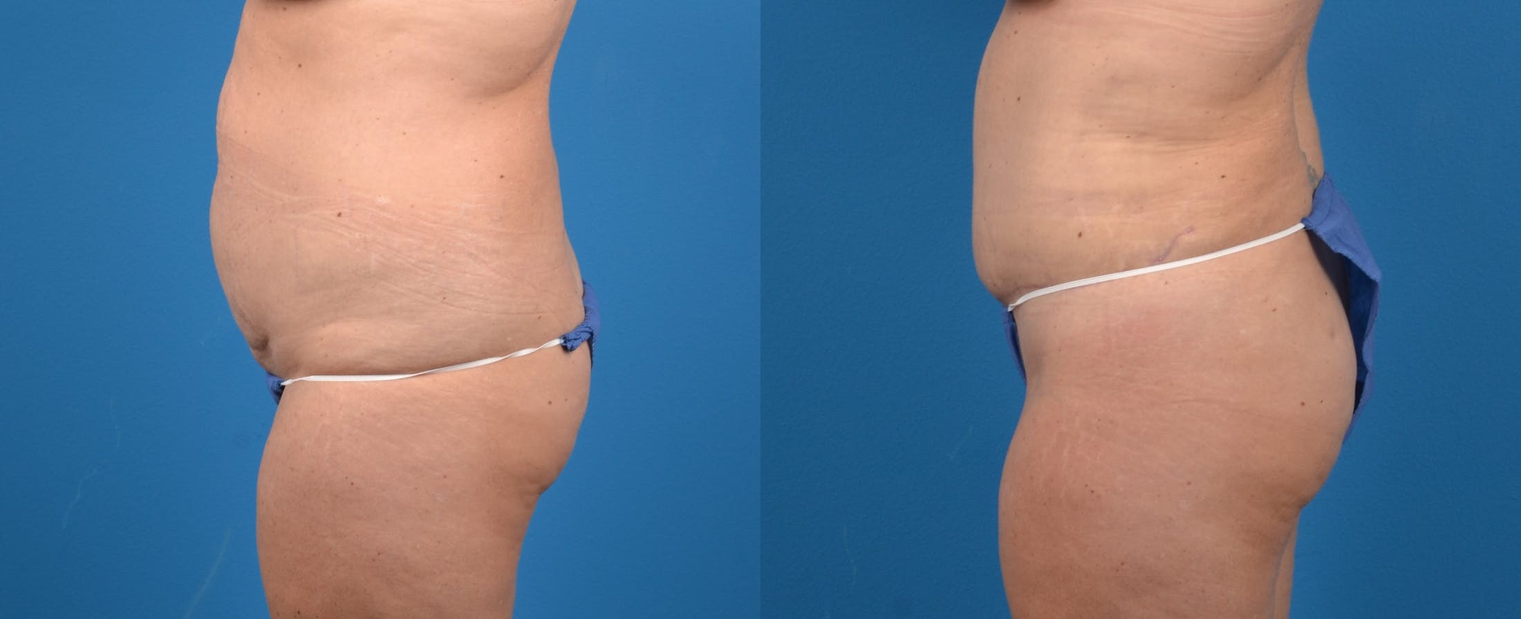 Liponique Body Contouring Before & After Gallery - Patient 122406058 - Image 2