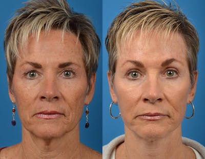 Facelift Before & After Gallery - Patient 122406063 - Image 1