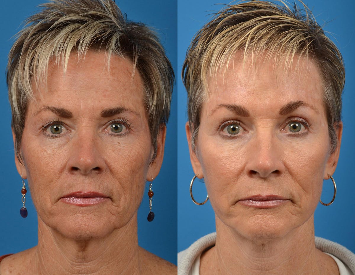 Facelift Before & After Gallery - Patient 122406063 - Image 1