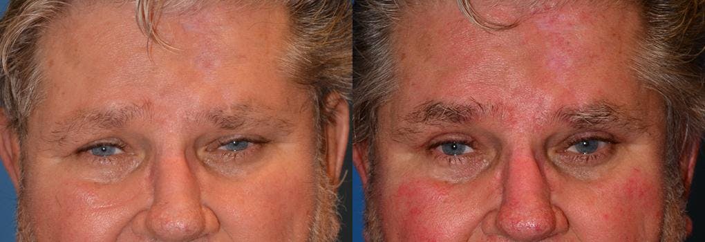 Eyelid Surgery Before & After Gallery - Patient 122406057 - Image 1