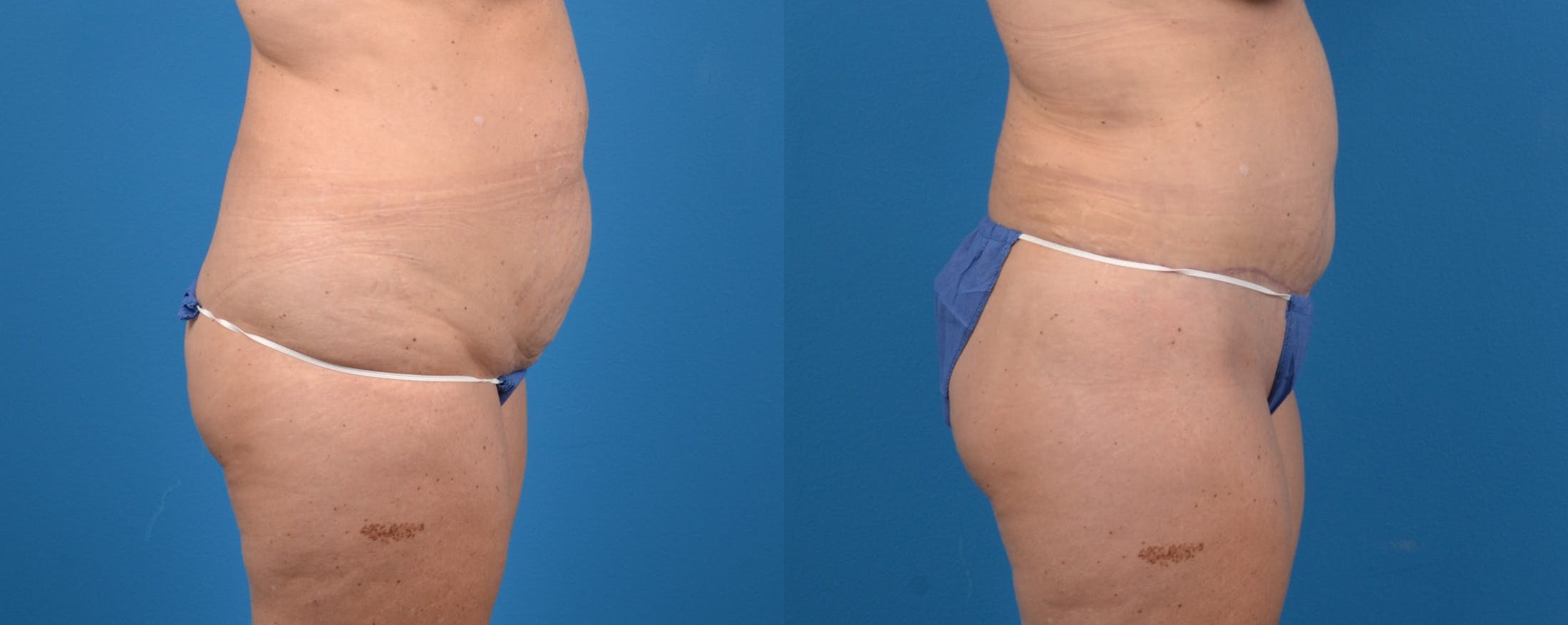 Liponique Body Contouring Before & After Gallery - Patient 122406058 - Image 3