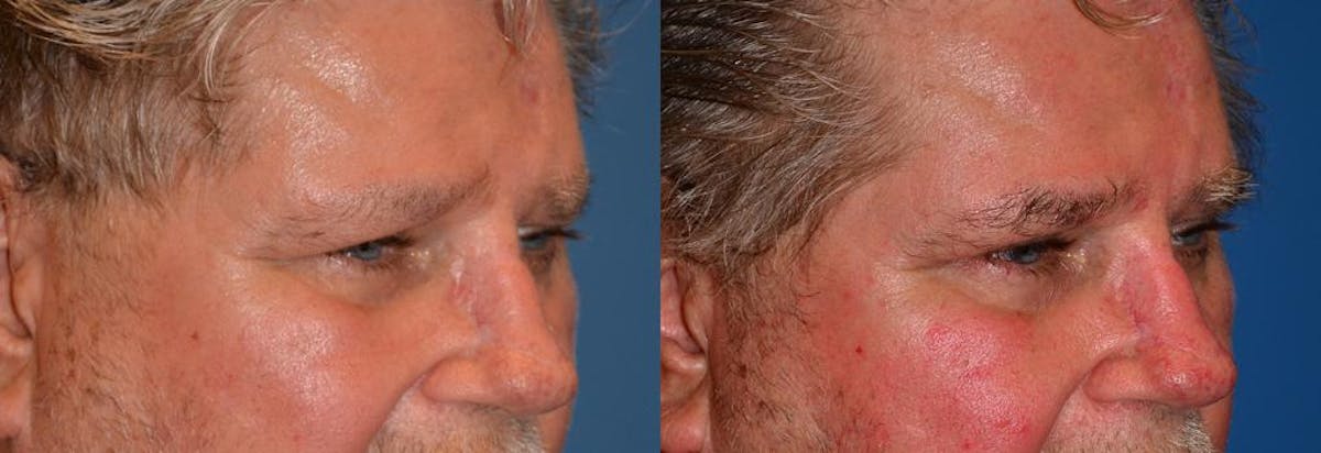Eyelid Surgery Before & After Gallery - Patient 122406057 - Image 2