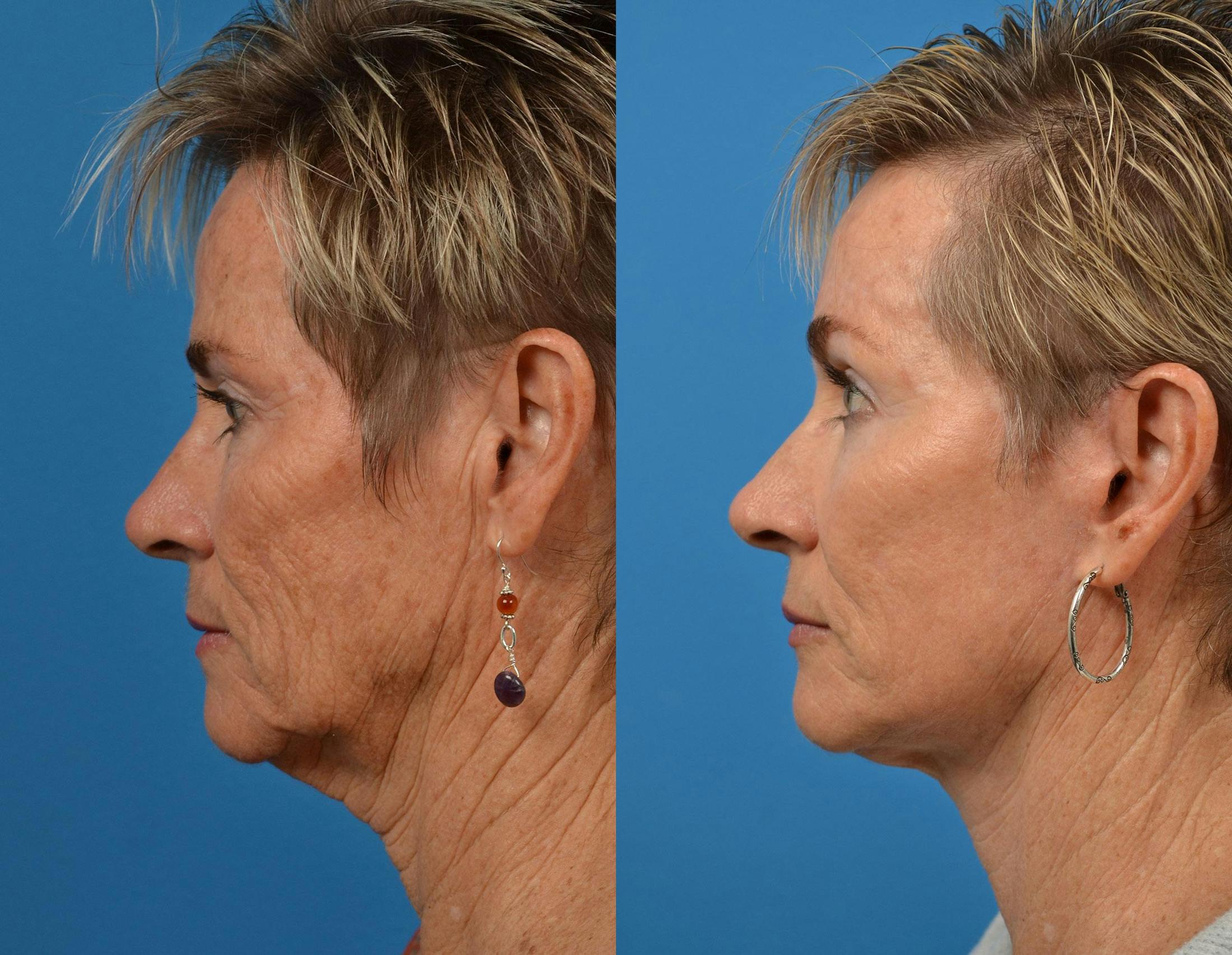 Facelift Before & After Gallery - Patient 122406063 - Image 2