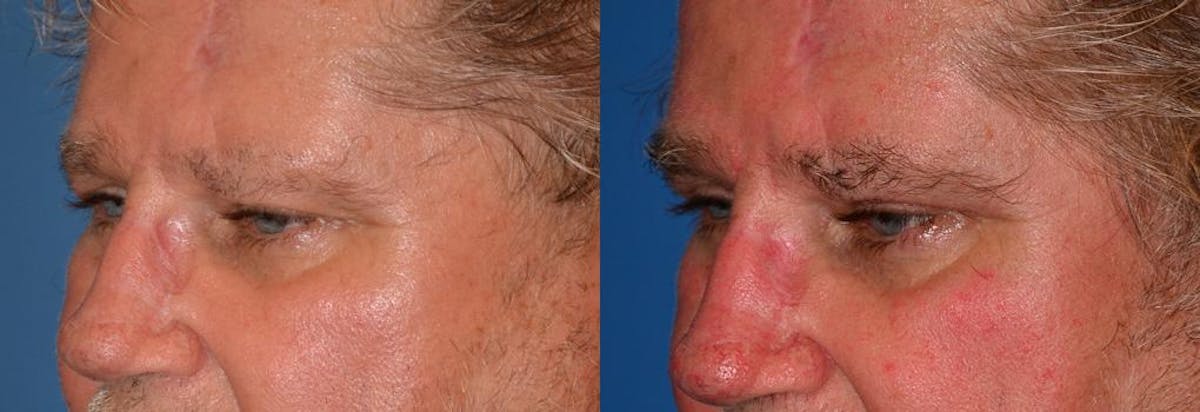 Eyelid Surgery Before & After Gallery - Patient 122406057 - Image 3
