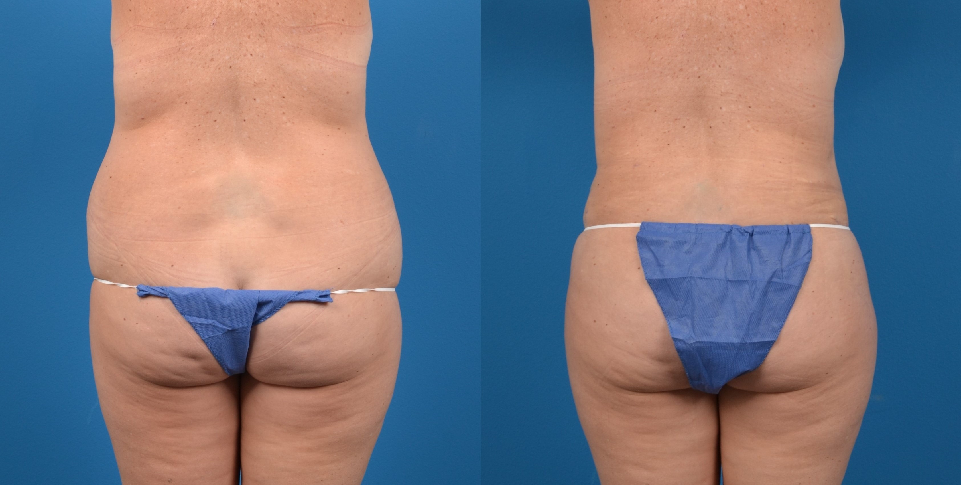 Hidden Liposuction  Before & After Gallery - Patient 336370 - Image 4