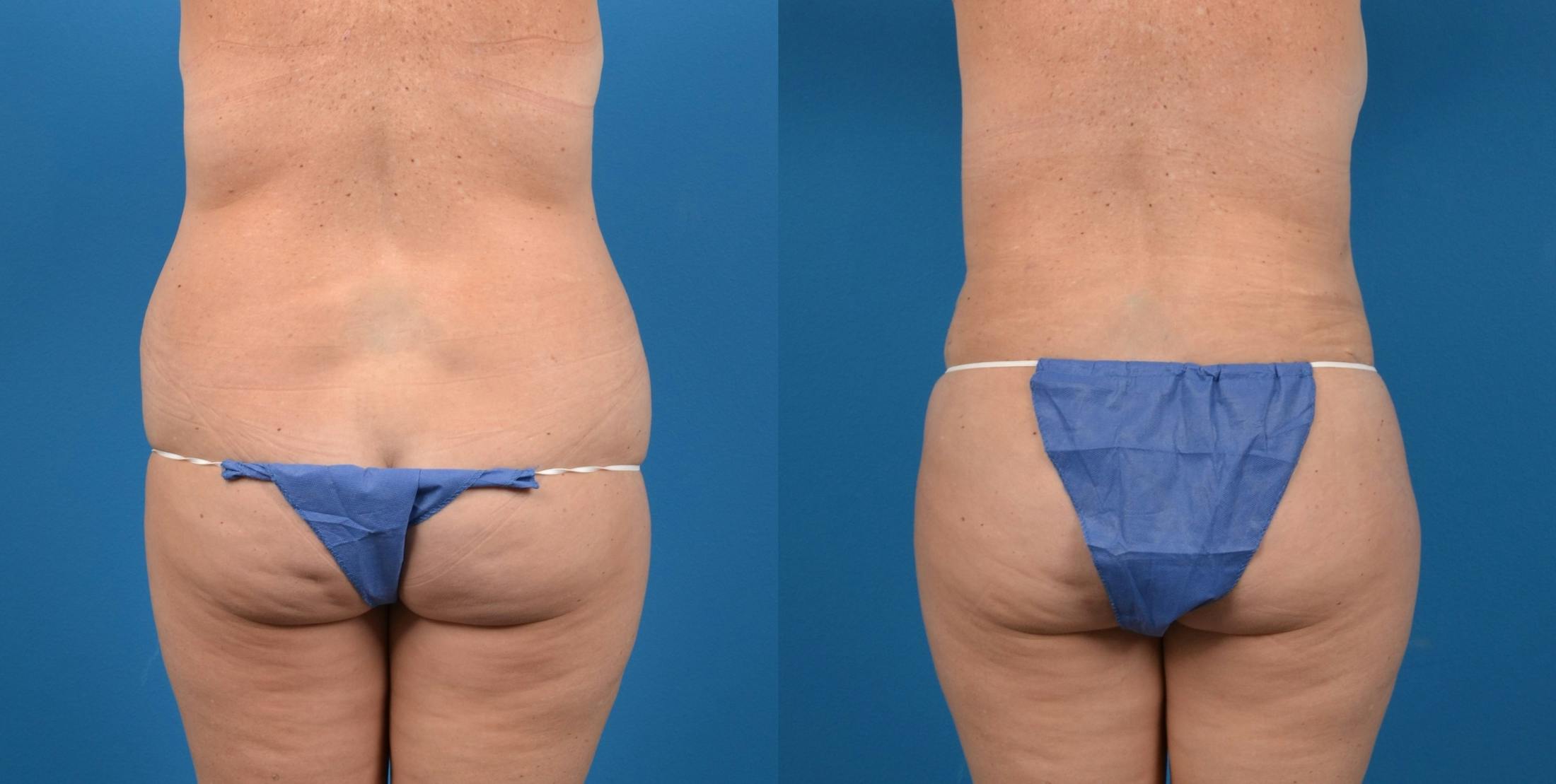 Liponique Body Contouring Before & After Gallery - Patient 122406058 - Image 4