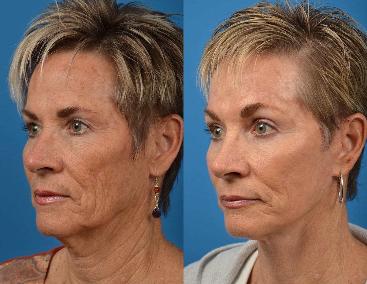 Facelift Before & After Gallery - Patient 122406063 - Image 3
