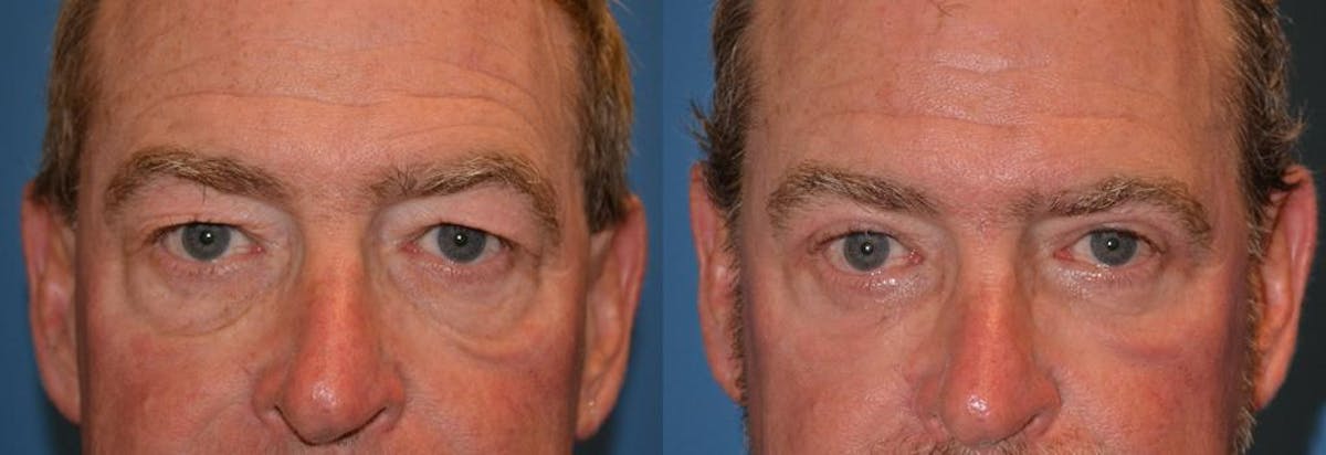 Eyelid Surgery Before & After Gallery - Patient 122406061 - Image 1