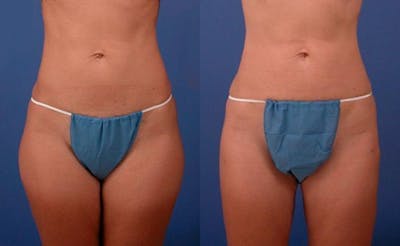 Liponique Body Contouring Before & After Gallery - Patient 122406059 - Image 1