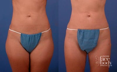 Hidden Liposuction  Before & After Gallery - Patient 896307 - Image 1