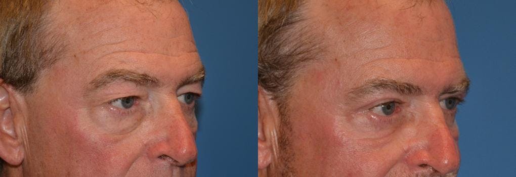 Eyelid Surgery Before & After Gallery - Patient 122406061 - Image 2