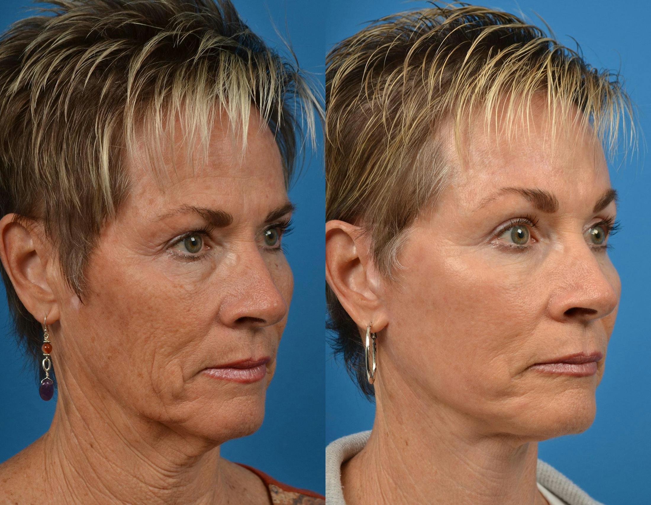 Facelift Before & After Gallery - Patient 122406063 - Image 4
