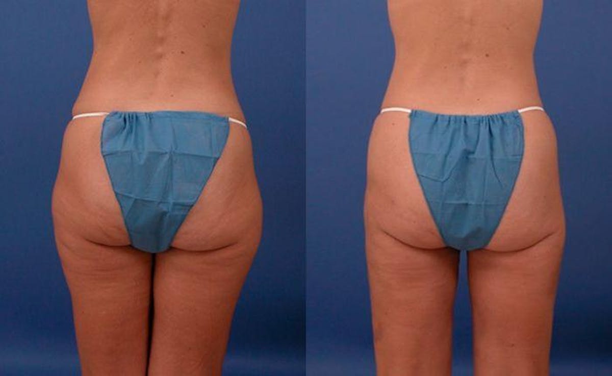 Liposuction Before & After Gallery - Patient 278103 - Image 2