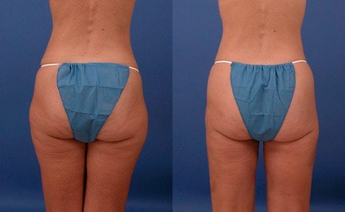 Liponique Body Contouring Before & After Gallery - Patient 122406059 - Image 2
