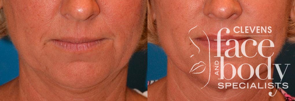 Lip Augmentation