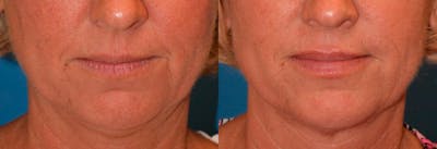 Lip Fillers Before & After Gallery - Patient 122406060 - Image 1